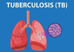 World Tuberculosis Day: 149 Die, 7,000 Infected In Cross River